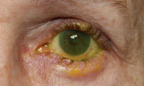 close up of males eye before receiving entropion eye repair