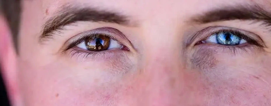 Male with heterochromia