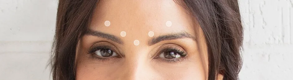 Dots on a womans forehead where dysport can be injected