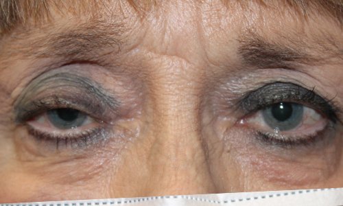 internal ptosis repair on both eyes