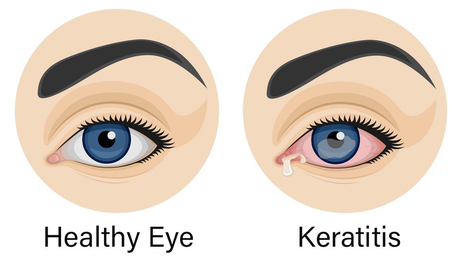 Healthy eye compared to a red watery eye with keratitis