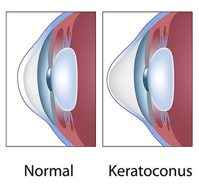 Diagram shows a normal cornea compared to an eye with keratoconus