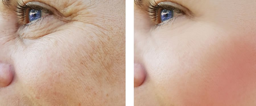 before and after skin resurfacing