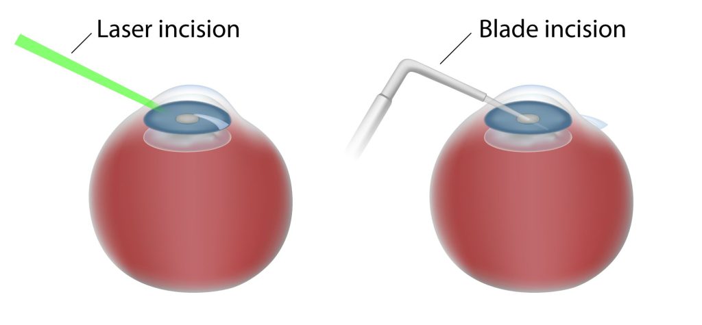 laser incision compared to blade incision cataract surgery