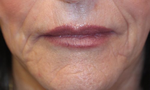 woman lips after restylane