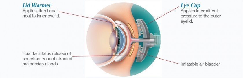 Diagram shows how LipiFlow dry eye treatment works on the eye