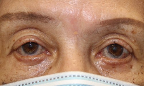 eyelid retraction repair on a female patient lower eyelid