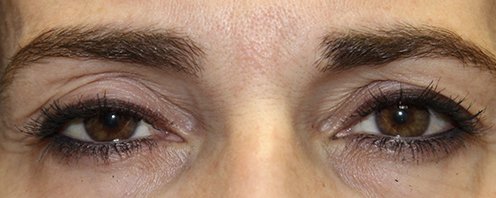 woman before ptosis surgery eye repair