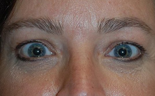lower eyelid blepharoplasty surgery after