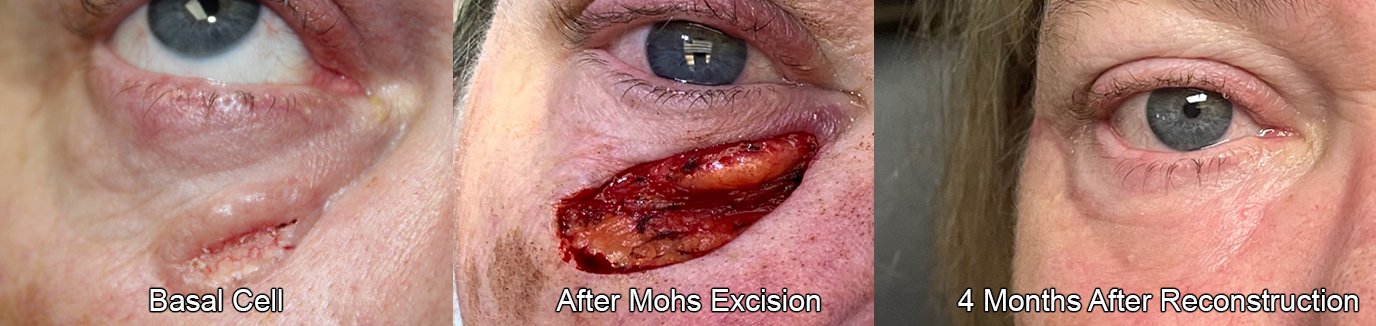 before and after MOHS excision with reconstructive surgery