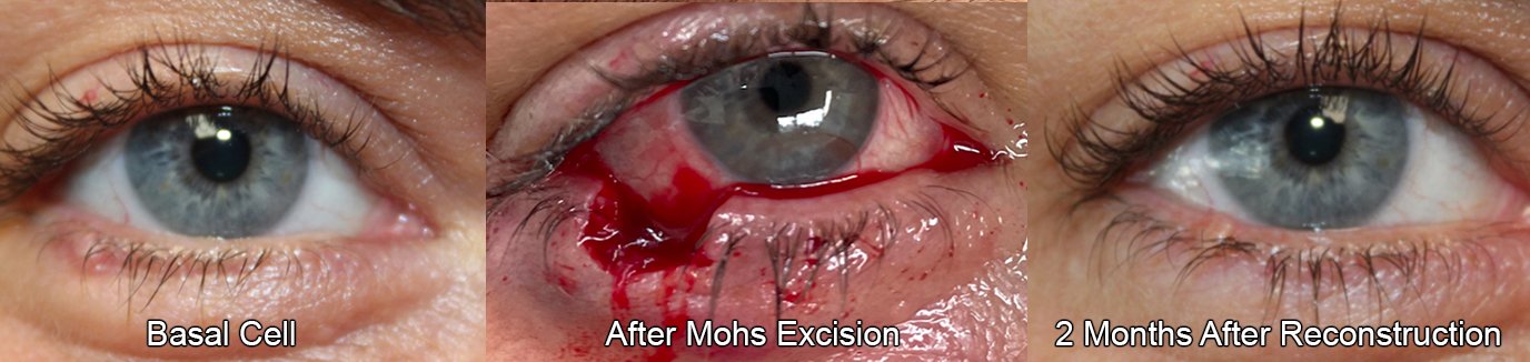 Mohs excision surgery before and after