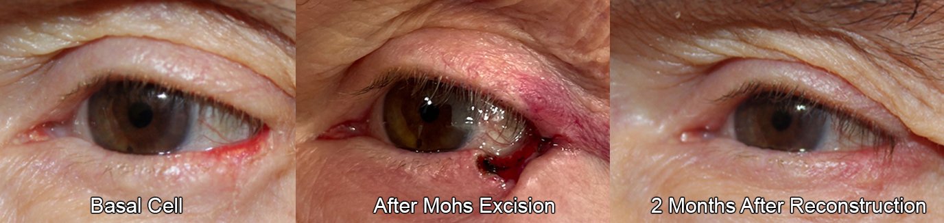 mohs excision surgery before and after with reconstruction