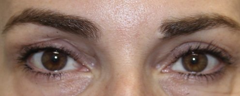 ptosis repair on female patient after surgery results