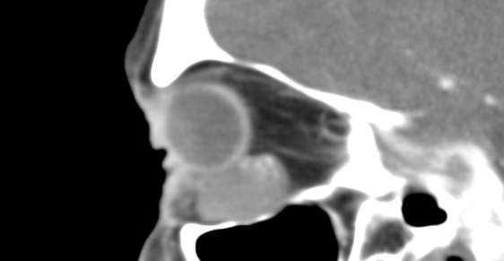 x-ray scan or orbital tumor removal
