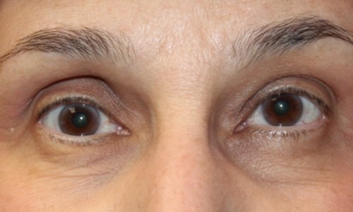 womans eyes before orbital tumor removal