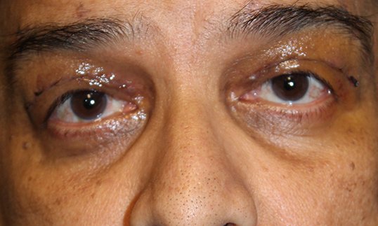 ptosis repair after surgery on female patient