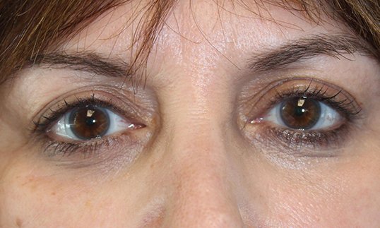 ptosis repair after on female patient