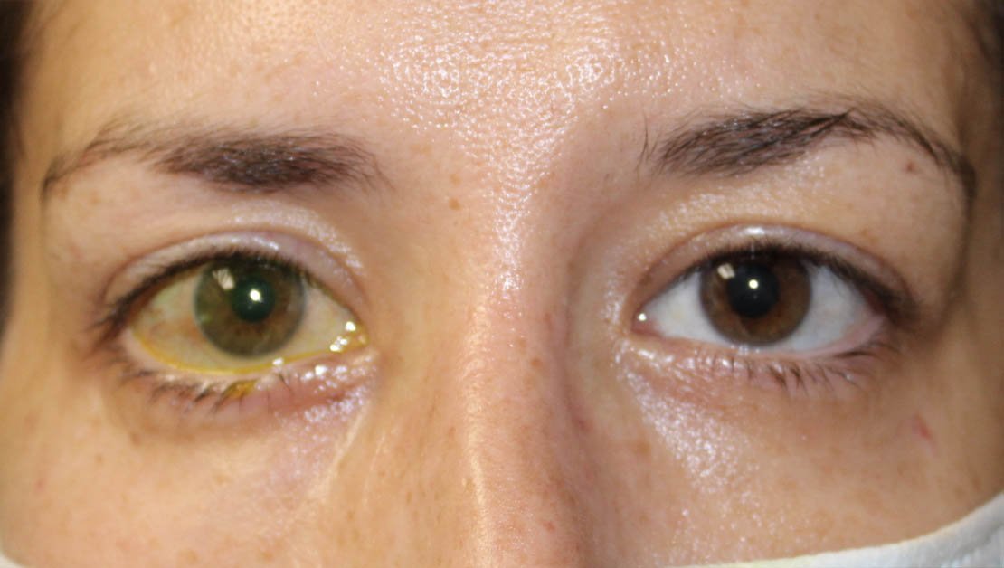 womans eye after receiving surgery treatment for facial paralysis