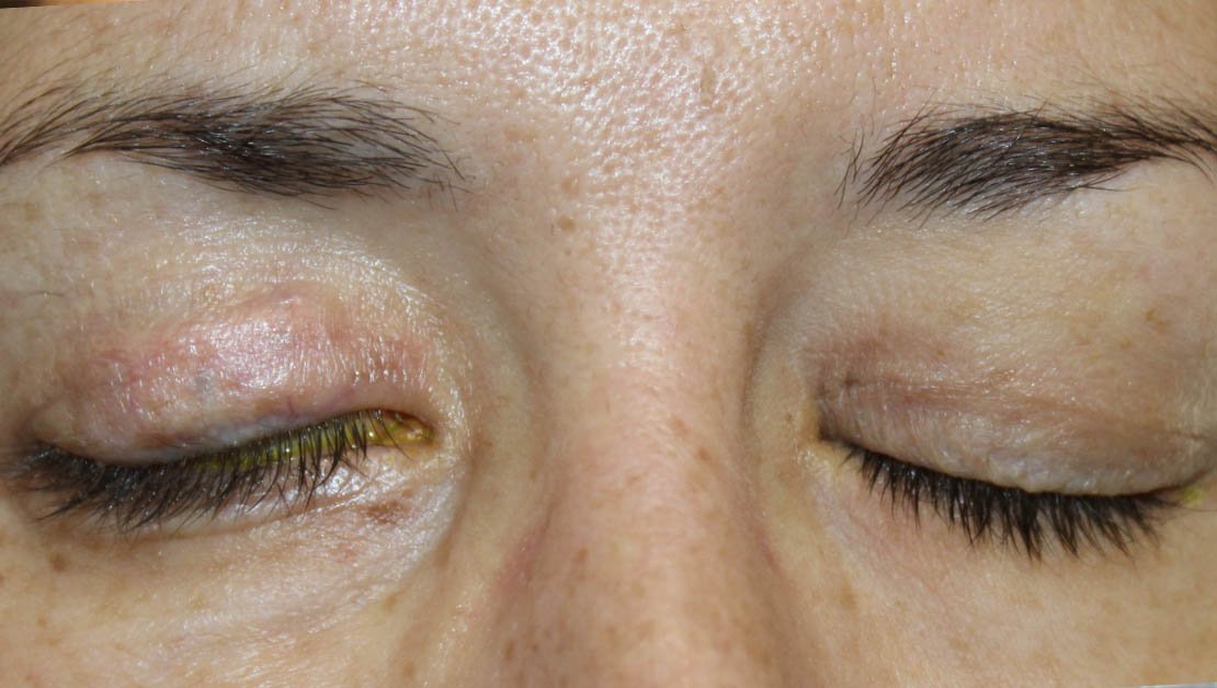closed womans eyes before surgery for facial paralysis