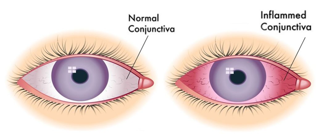 Illustration of a red irritated eye with conjunctivitiss