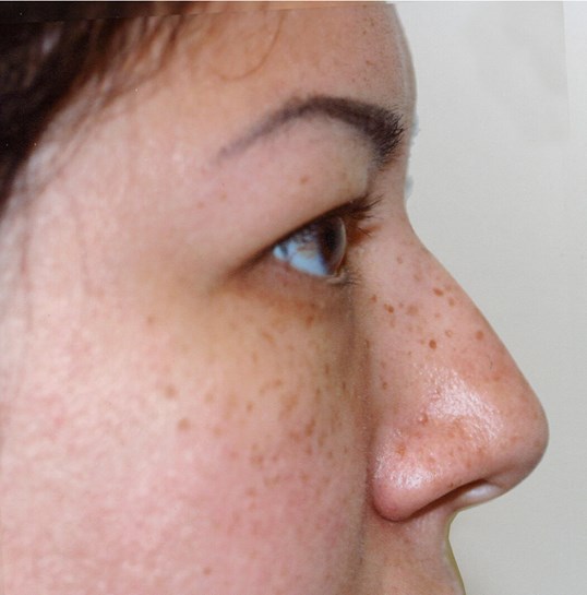 side profile of a woman before and after juvederm