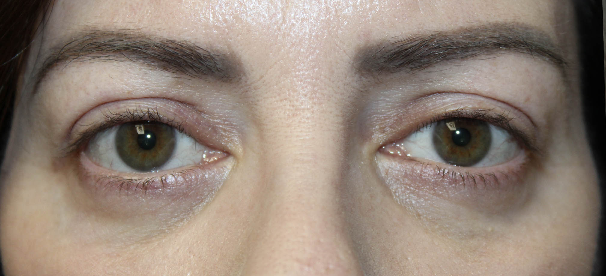 woman eyes open upper and lower blepharoplasty surgery results