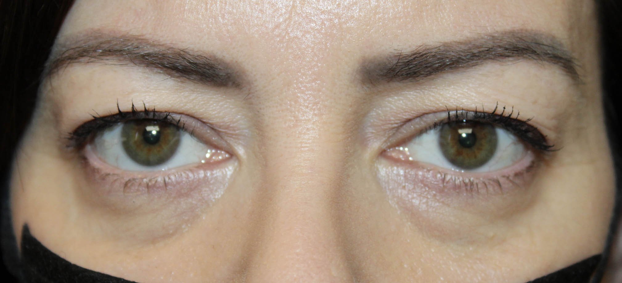 woman eyes open upper and lower blepharoplasty results