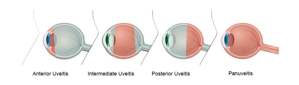 Illustration showing the different types of uveitis