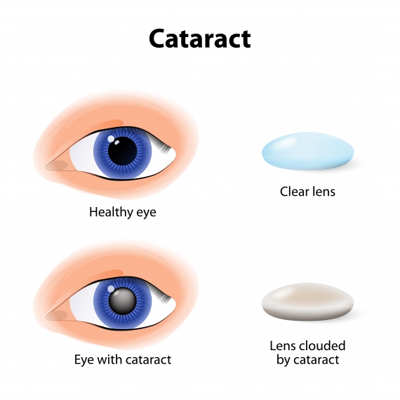 Cataract Surgery Before and After
