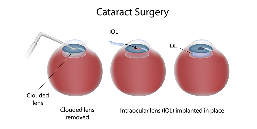 Cataract Surgery Explained
