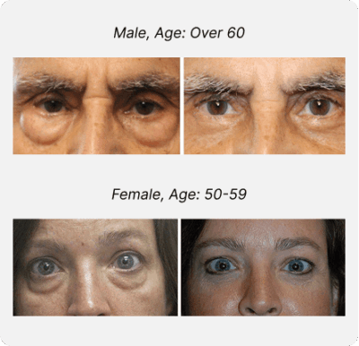 Blepharoplasty Before and After