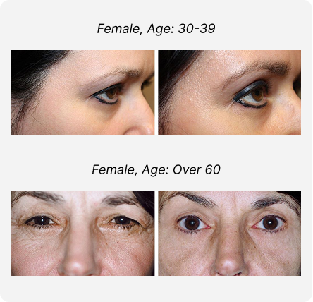 Blepharoplasty Before and After