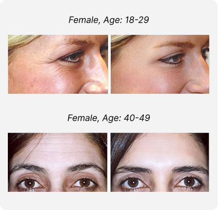 Blepharoplasty Before and After