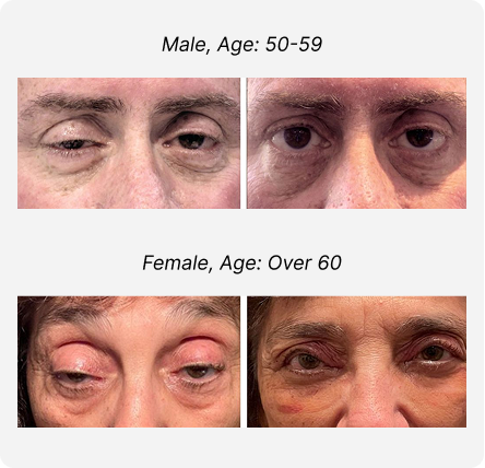 Blepharoplasty Before and After