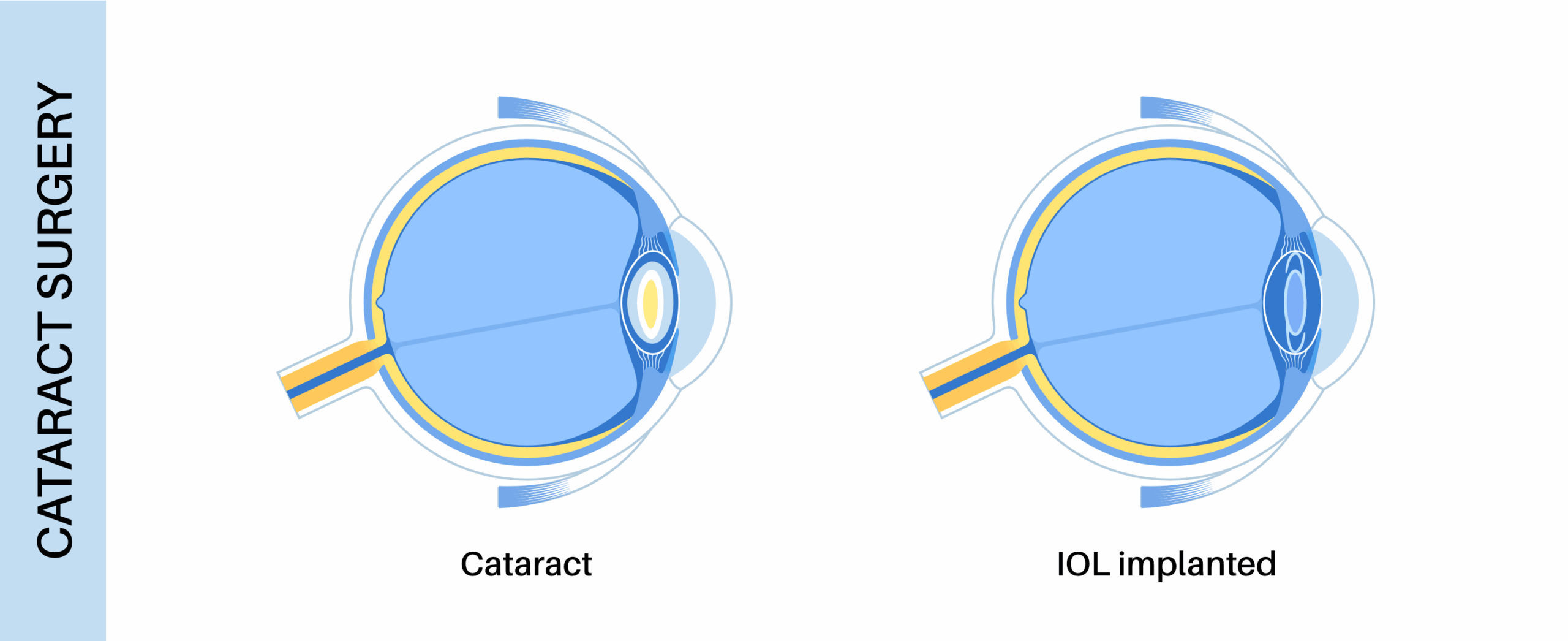 Cataract Surgery Explanation