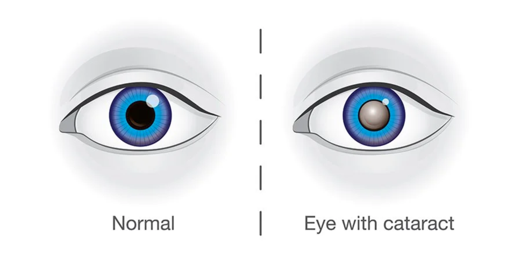 Eye with cataract