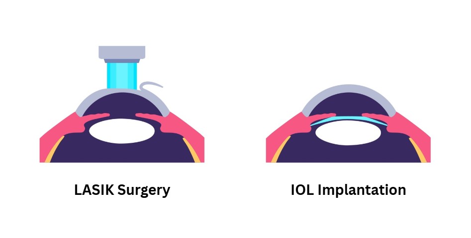 LASIK vs IOL
