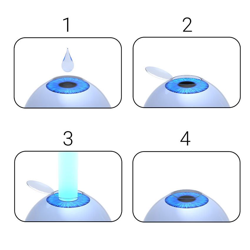 Laser-eye-surgery-procedure.-Lasik-vision-correction.-Collage-illustration.-3D-rendering.