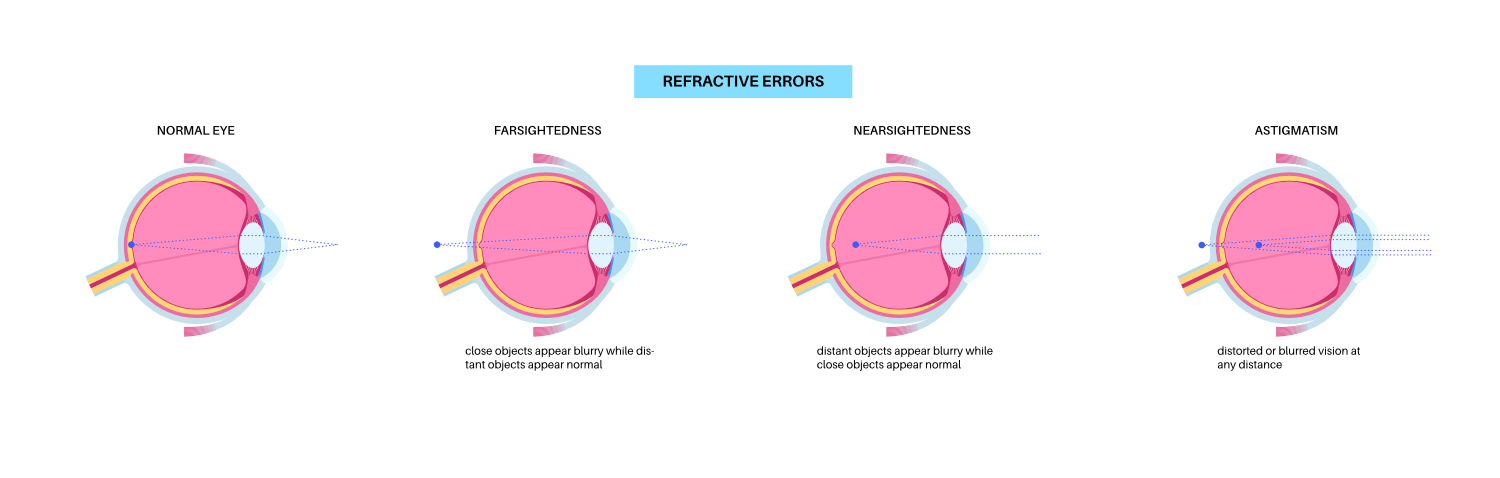 Normal eye, astigmatism, myopia and hyperopia diseases Nearsightedness and farsightedness concept Short sightedness, long sightedness vision disorder
