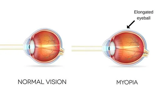Normal-vs-Myopia