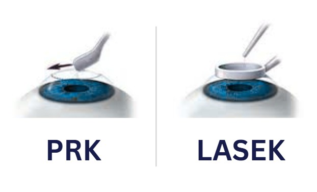 PRK VS LASEK
