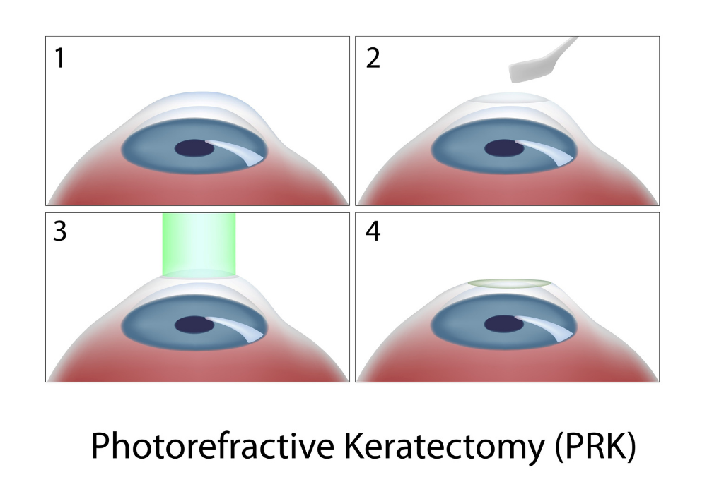 Photorefractive Keratectomy (PRK) surgery