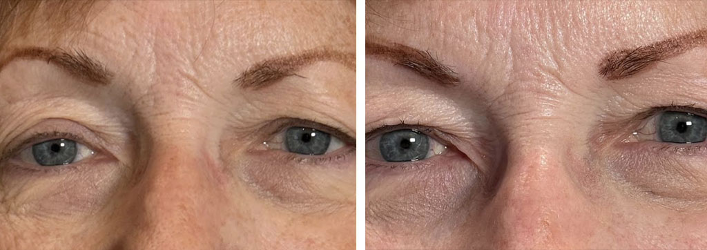Conservative MMCR to mitigate Ptosis and Symmetrize Eyelids (2 weeks Post OP)