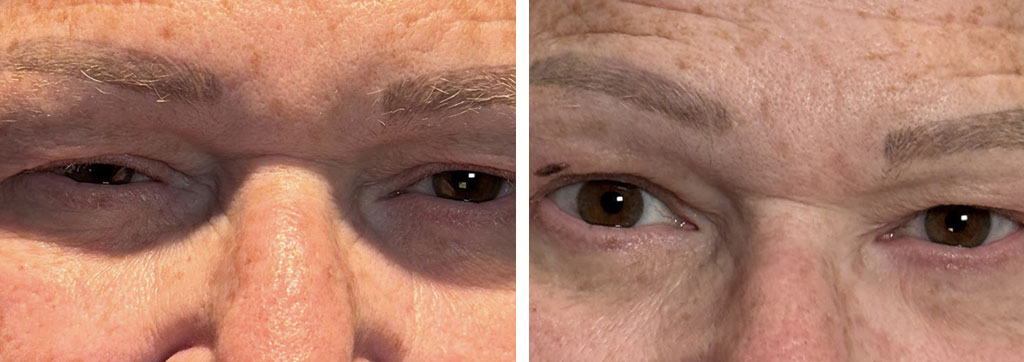 Ptosis Repair