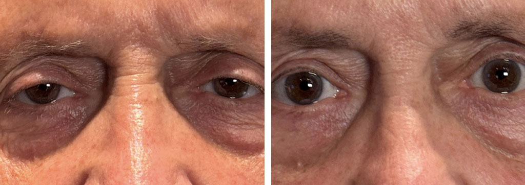 Ptosis Surgery