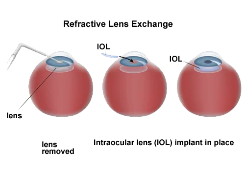 Refractive-Lens-Exchange