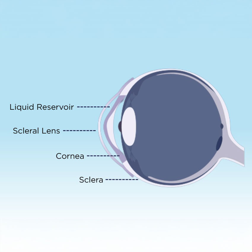Scleral-Contact-Lenses