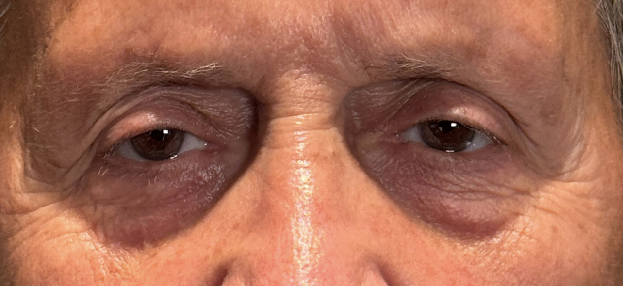 Ptosis Surgery Before