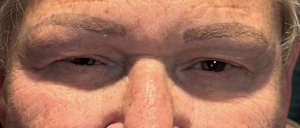 Ptosis Repair Before