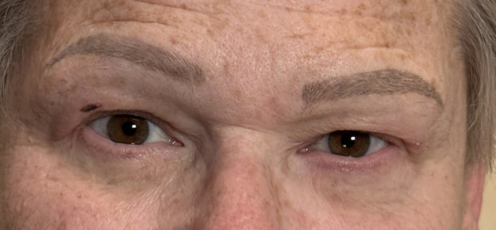 Ptosis Repair After
